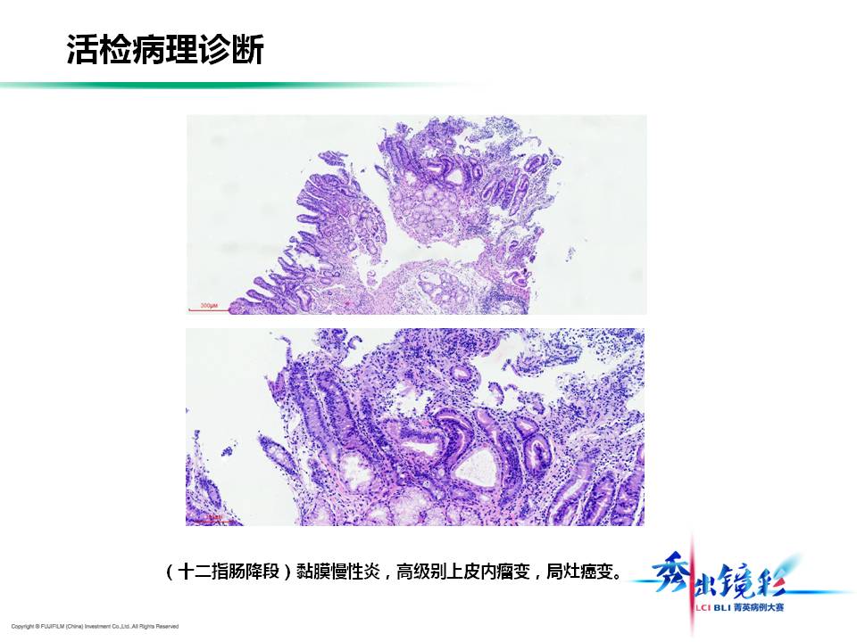 十二指肠降段黏膜腺癌