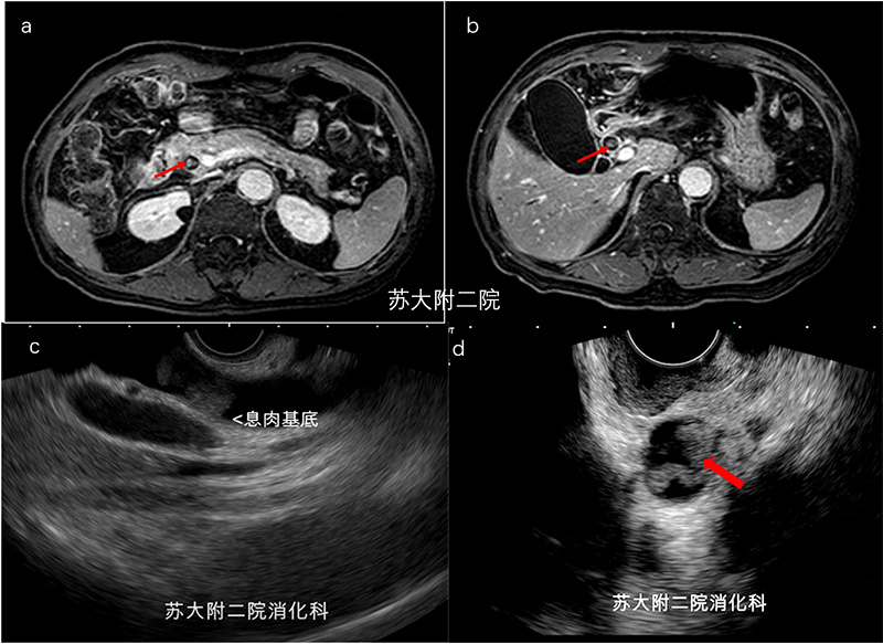 (图1 a,b:mri示胆总管腔内稍高信号,考虑结石.