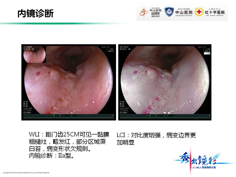 食管鱗狀細胞癌