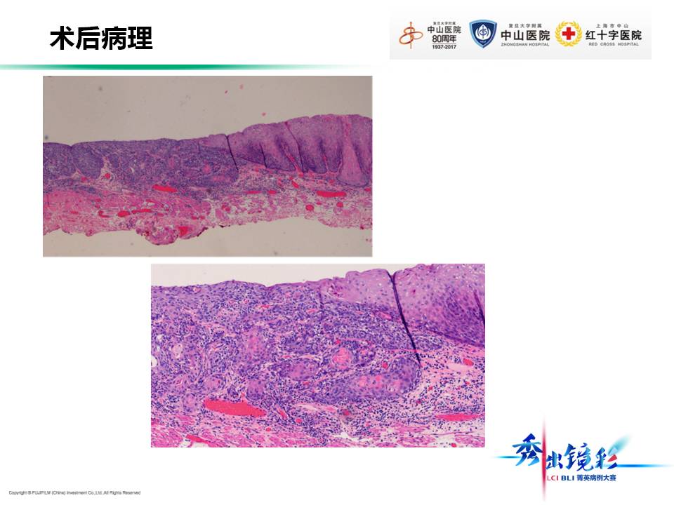 食管鱗狀細胞癌