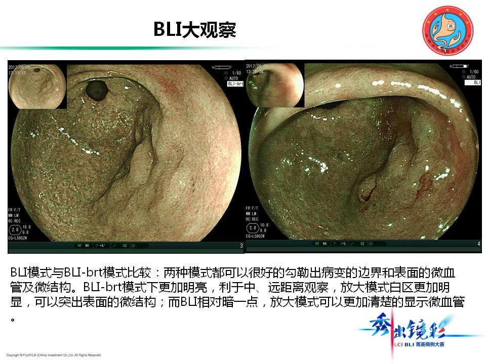 胃窦iiaiic型早癌