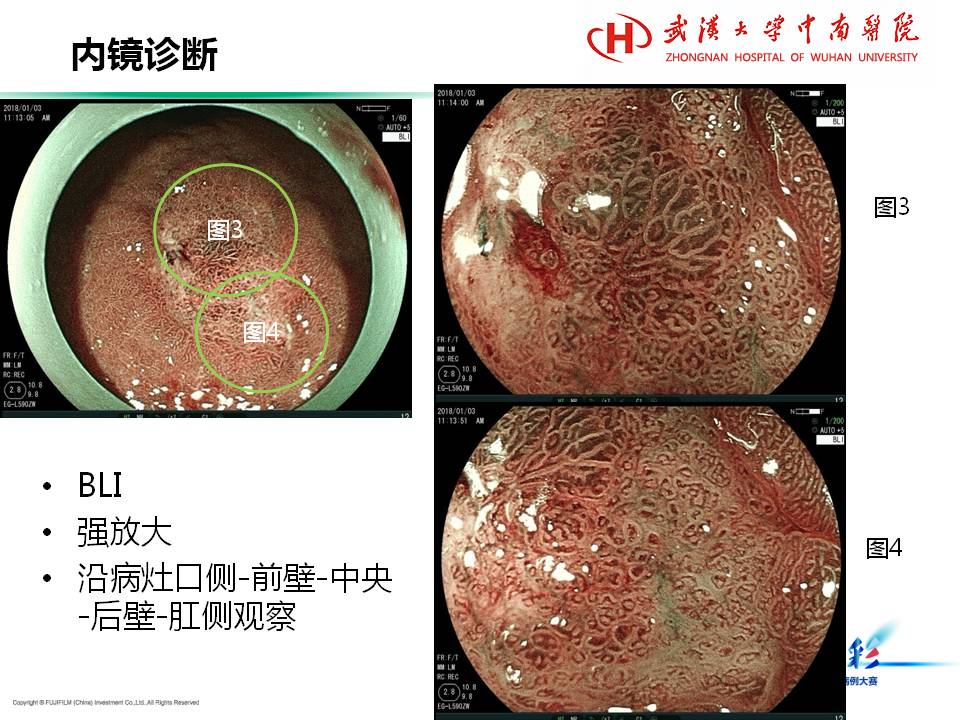 胃竇早期癌esd