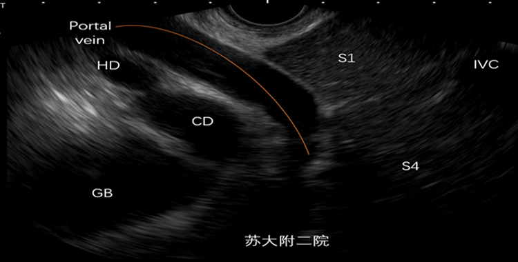 图片 1 胃食管连接部扫查.png