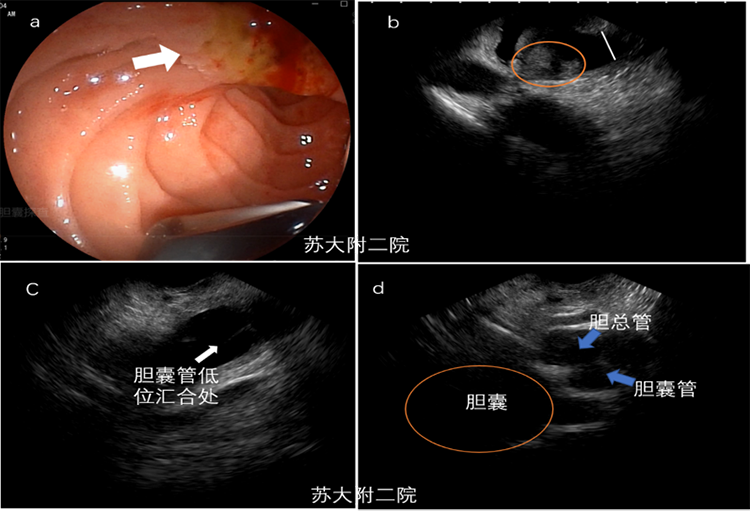 图片 4 乳头癌病例累及胆管.png