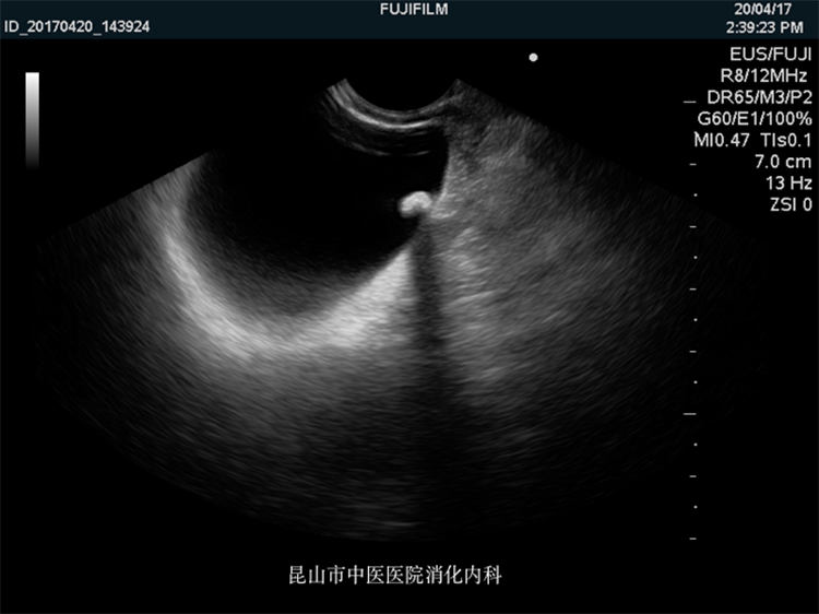 图片 8 胆囊单发结石.png