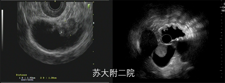 图片 14 胆囊癌.png