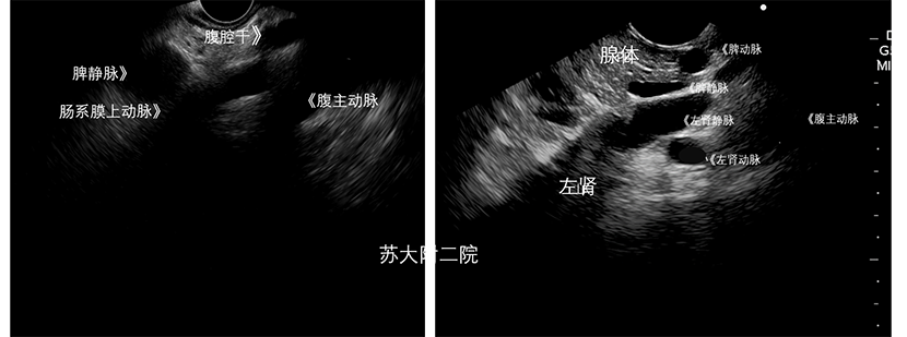 腹腔大血管解剖图超声图片
