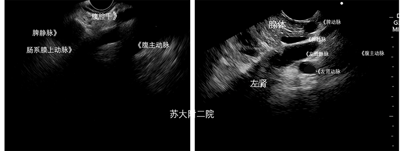 经典超声内镜病例腹主动脉主要分支的探查技巧和典型病例