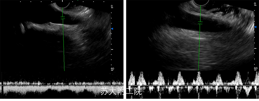 经典超声内镜病例:腹主动脉主要分支的探查技巧和典型病例