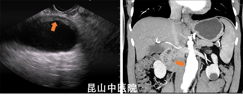 经典超声内镜病例:腹主动脉主要分支的探查技巧和典型病例