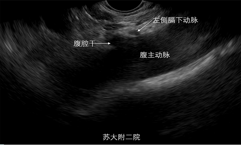 图4左膈下动脉png