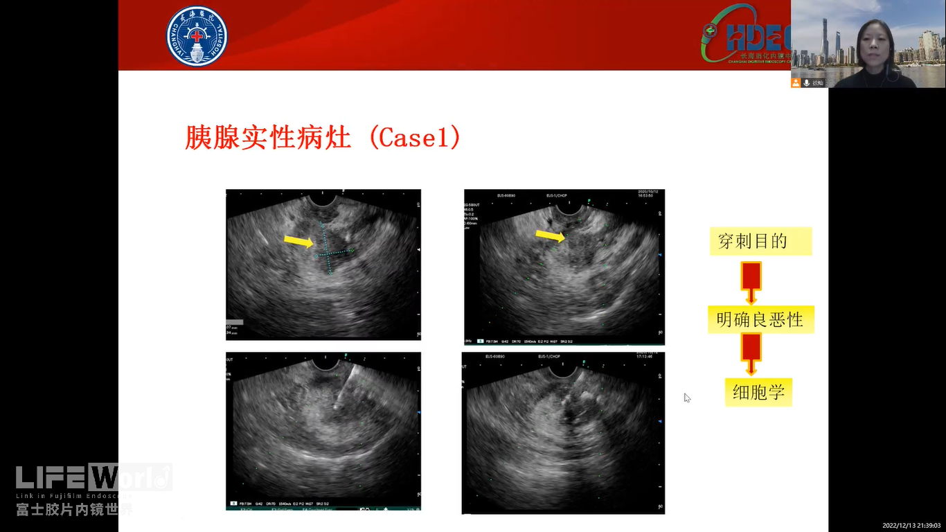 胰腺实性病灶（图1）.png