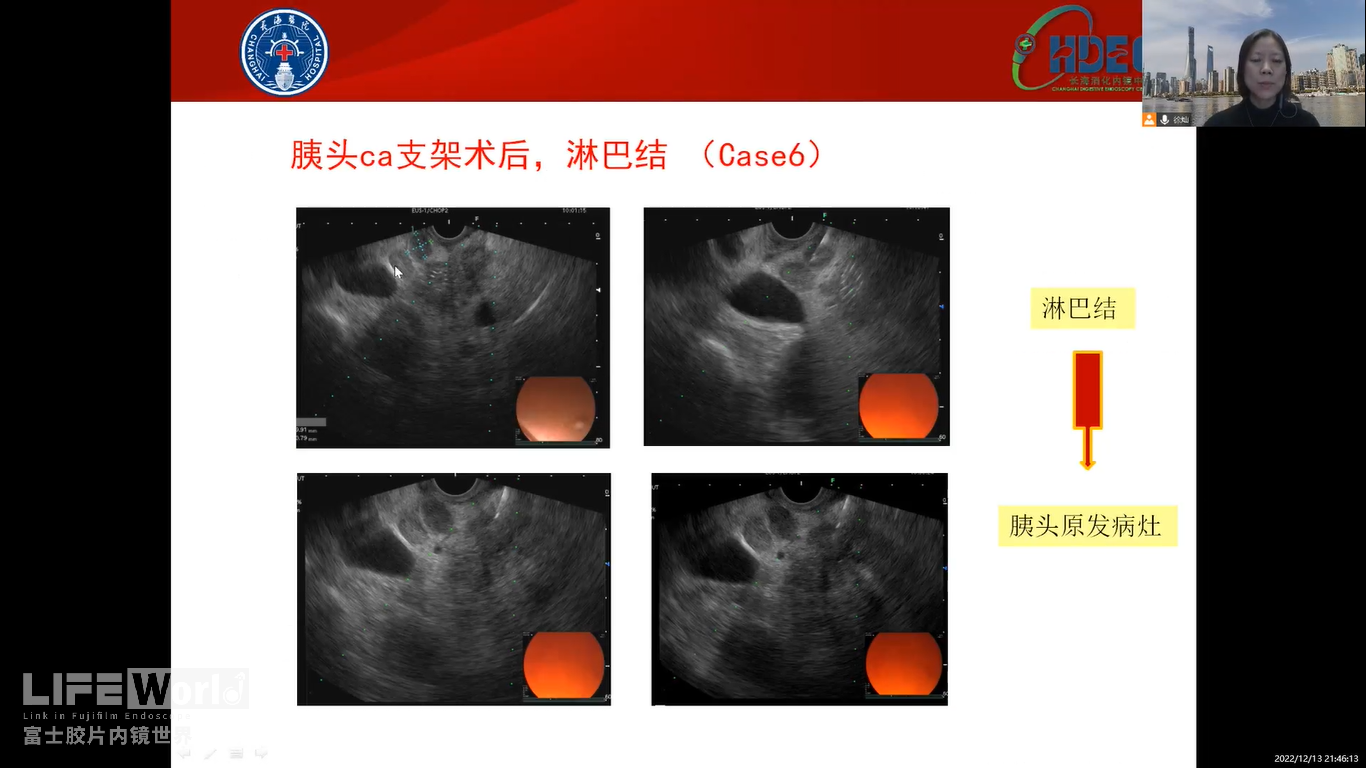 淋巴结（图4）.png